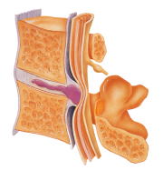 脱出(transligamentous extrusion)